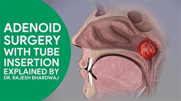 How do you get rid of bad breath after adenoid surgery?