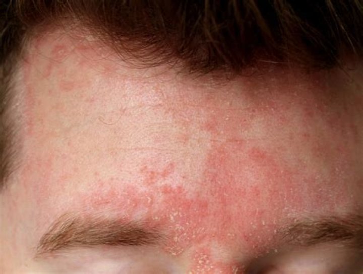 How do you treat seborrheic dermatitis on the face?