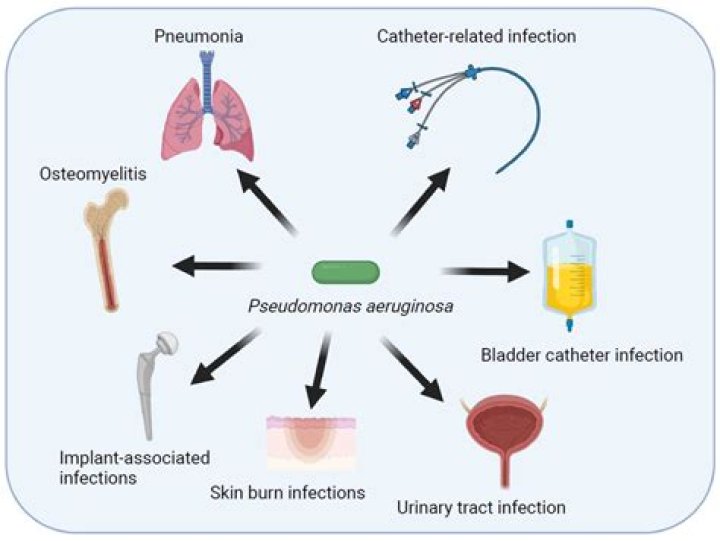 How is Pseudomonas cellulitis treated?