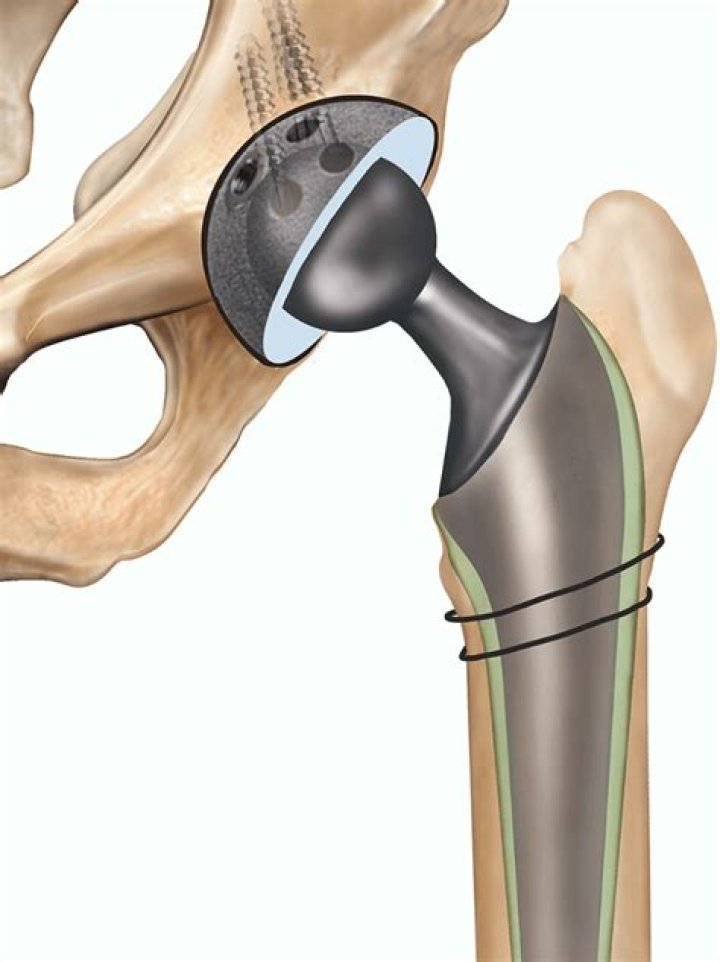 How long does it take to fully recover from a total hip replacement?