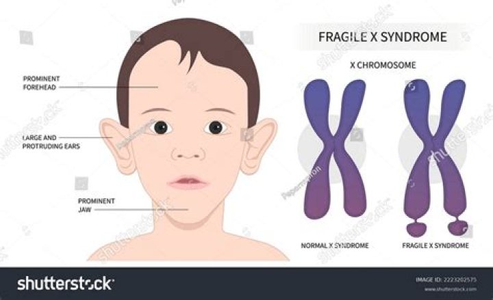 What is the life expectancy of a child with fragile X syndrome?
