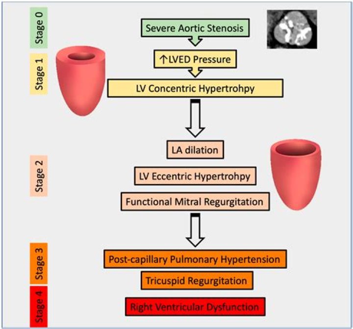 What is the pathophysiology of mitral valve disease?